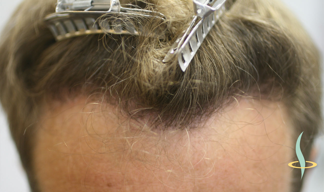 Resim 11: Otojen saç transplantasyonundan sonra saç çizgisi.