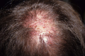 Bir erkeğin kafa derisi üzerinde suni saç implantlardan dolayı meydana gelen iltihapların ve yara dokusunun görünümü